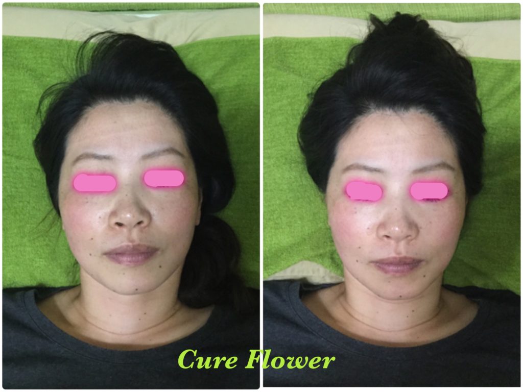 小顔矯正、small face correction