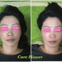 小顔矯正、small face correction