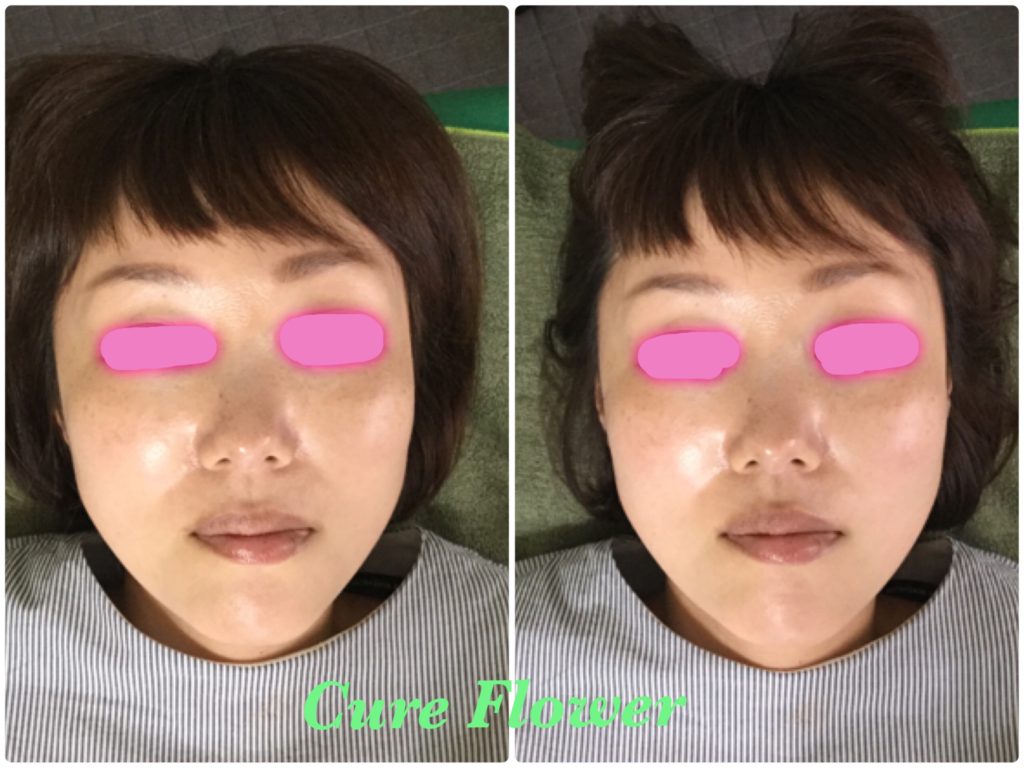 小顔矯正、small face correction