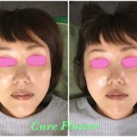 小顔矯正、small face correction