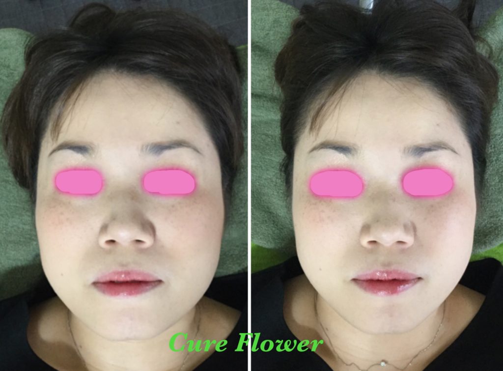 小顔矯正、small face correction