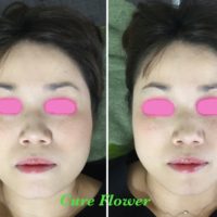 小顔矯正、small face correction