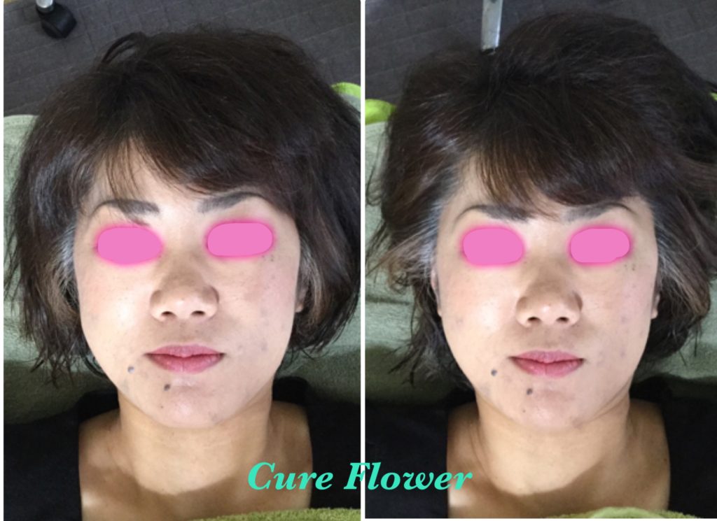 小顔矯正、small face correction