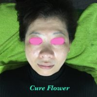 小顔矯正、small face correction