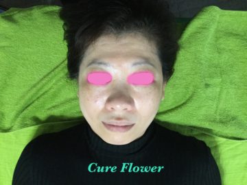 小顔矯正、small face correction