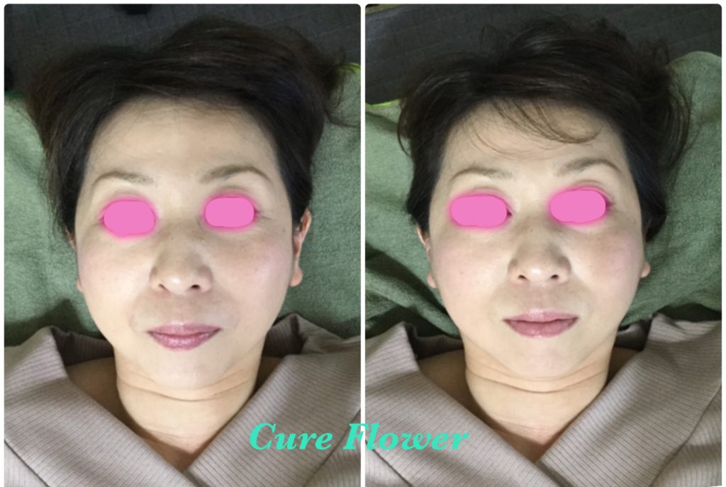 小顔矯正、small face correction