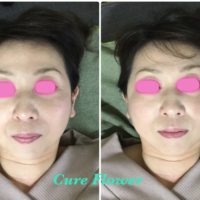 小顔矯正、small face correction