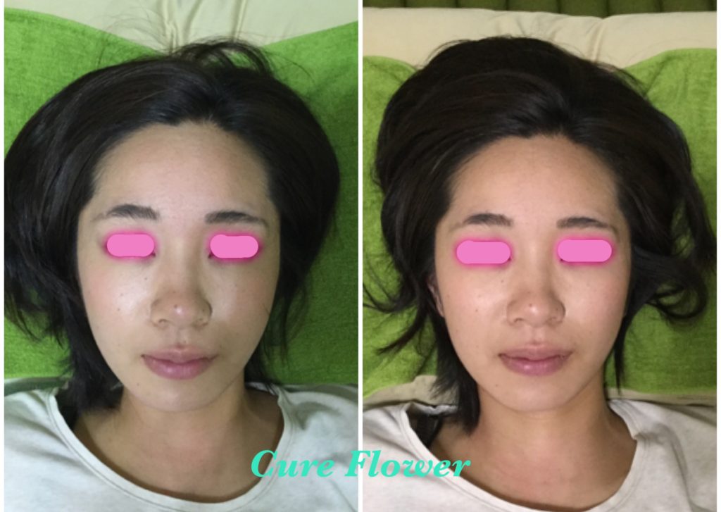 小顔矯正、small face correction