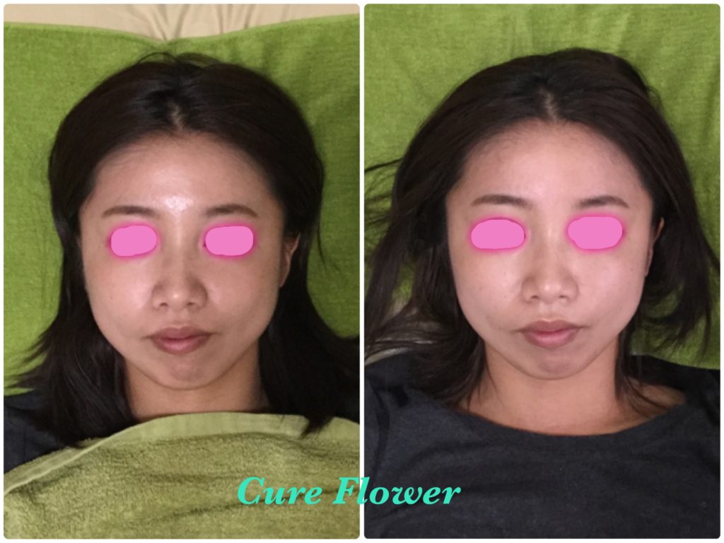 小顔矯正、small face correction