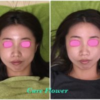 小顔矯正、small face correction