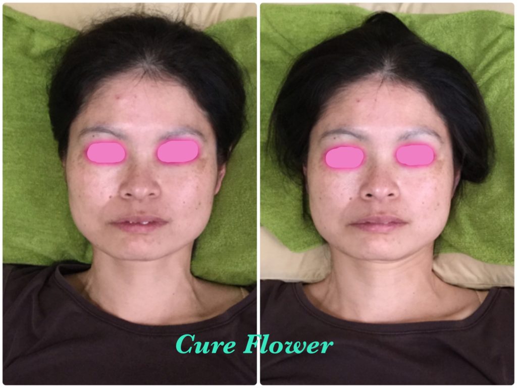 小顔矯正、small face correction