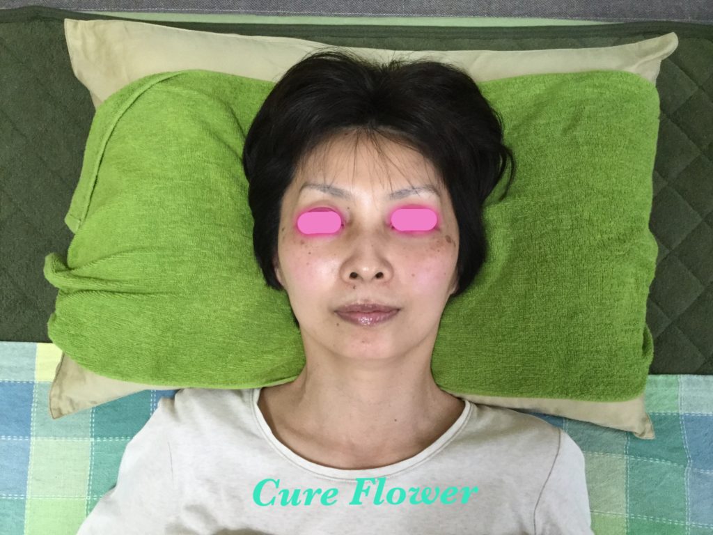 小顔矯正、small face correction