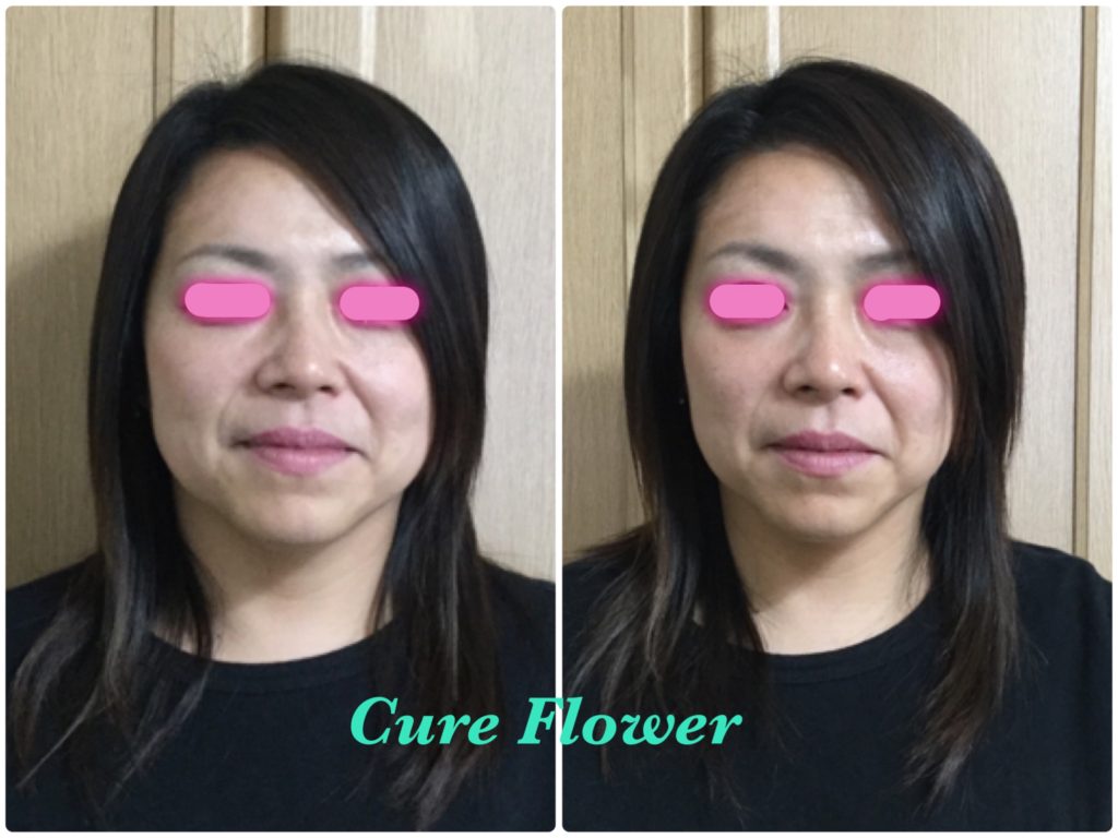 小顔矯正、small face correction