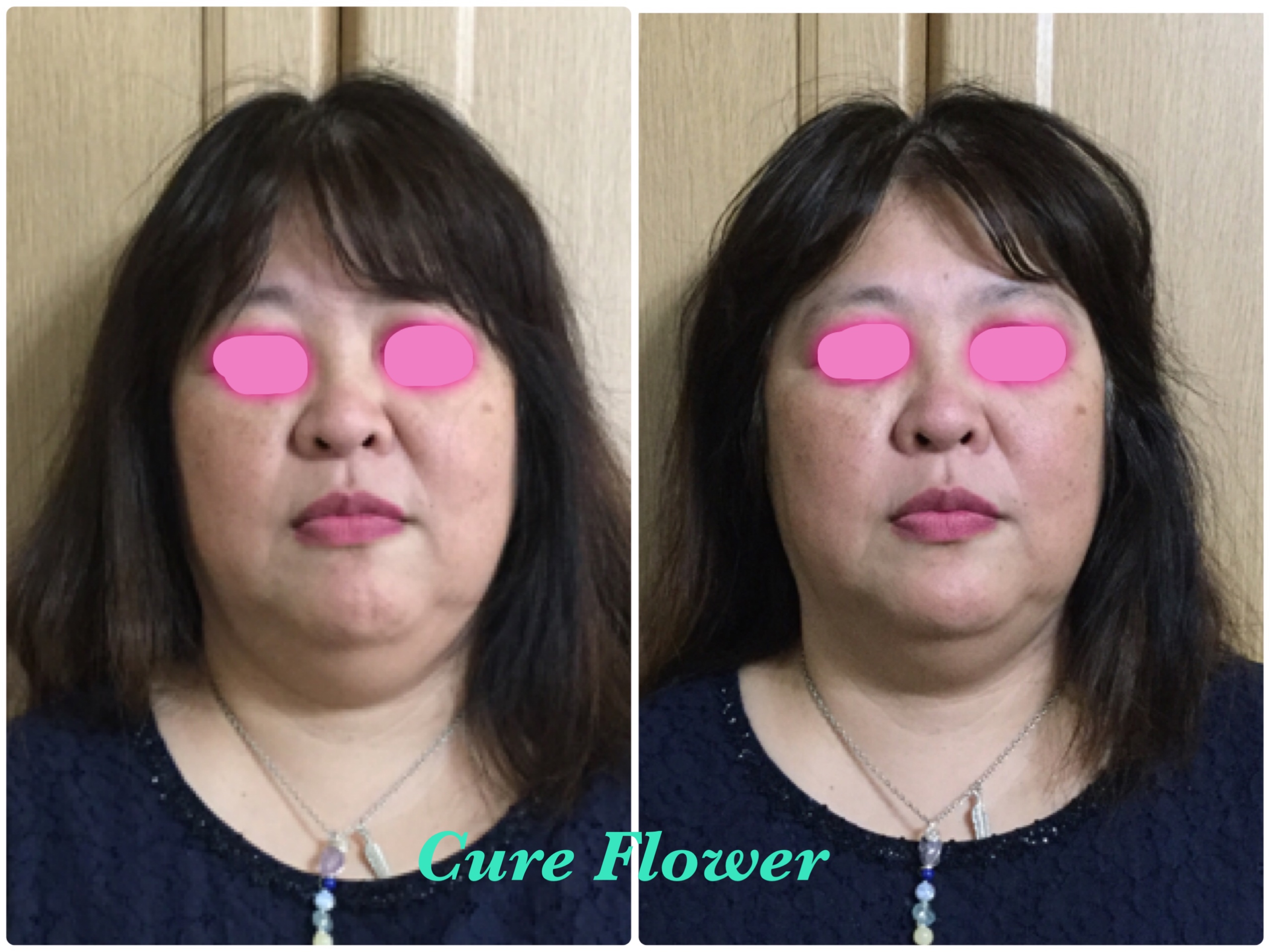 小顔矯正、small face correction