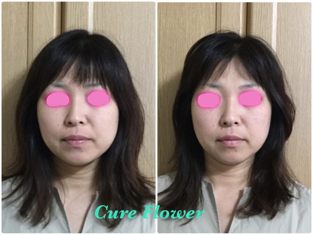 小顔矯正、small face correction