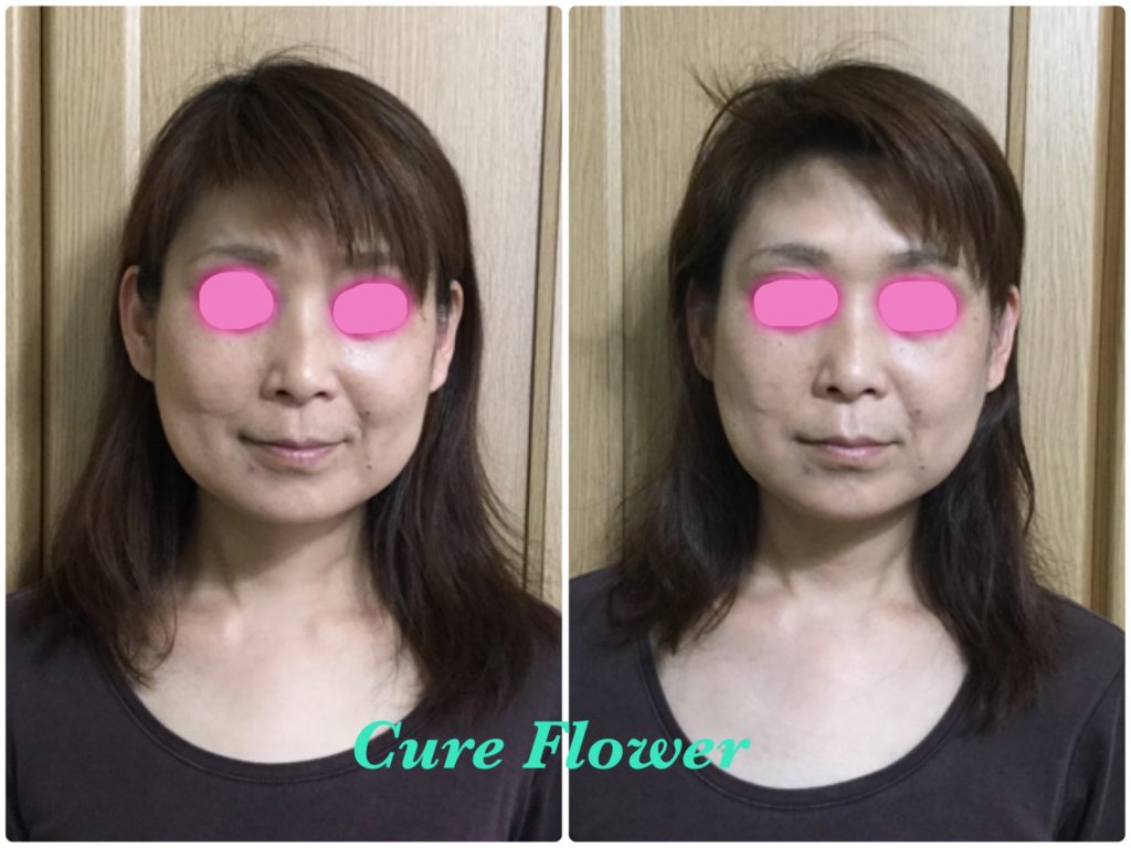 小顔矯正、small face correction