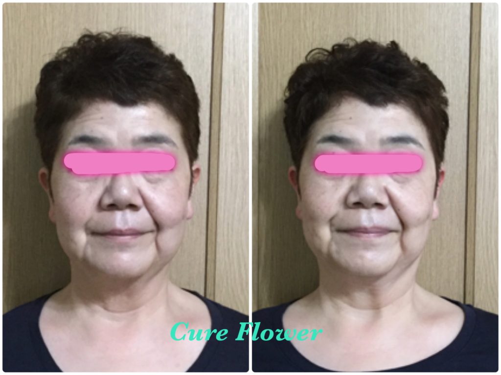 小顔矯正, small face correction