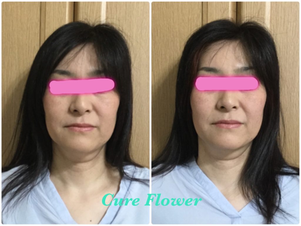 小顔矯正, small face correction