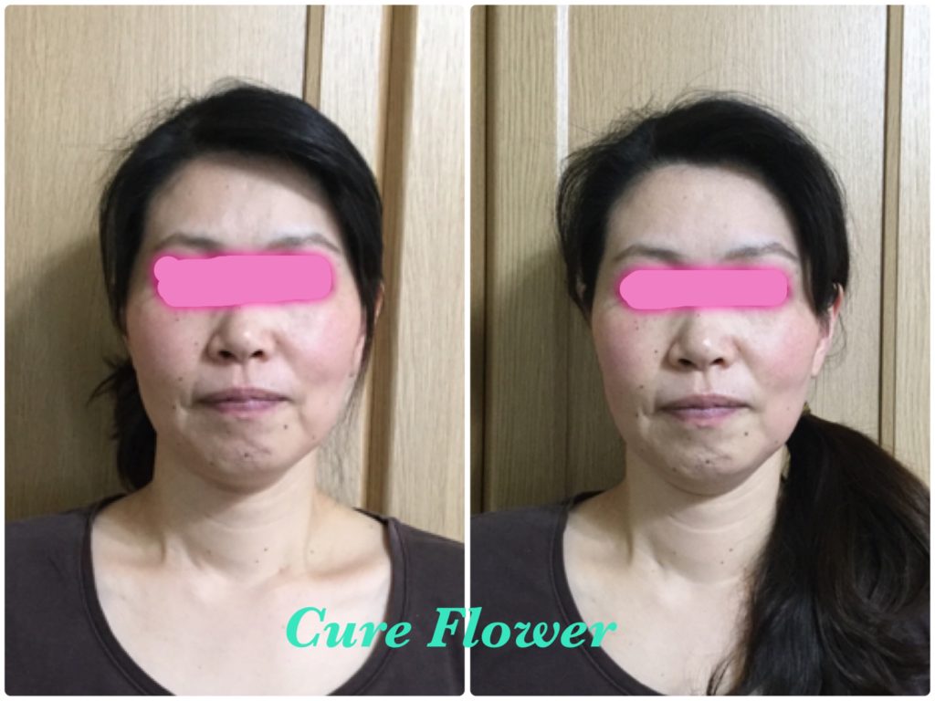 小顔矯正, small face correction