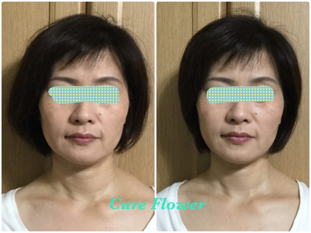 小顔矯正,　small face correction