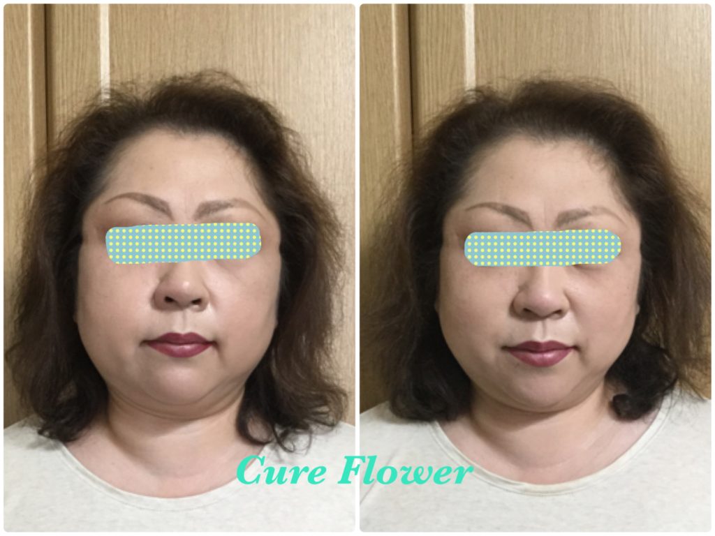 小顔矯正,　small face correction