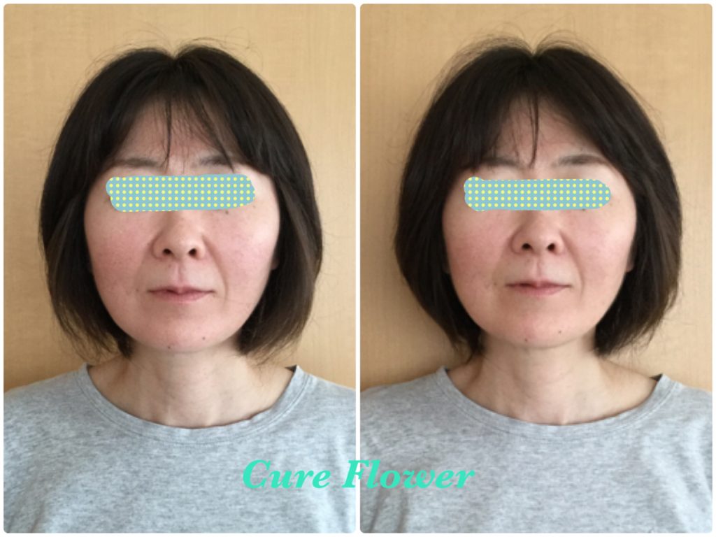 小顔矯正,　small face correction