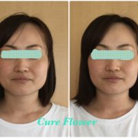 小顔矯正,　small face correction