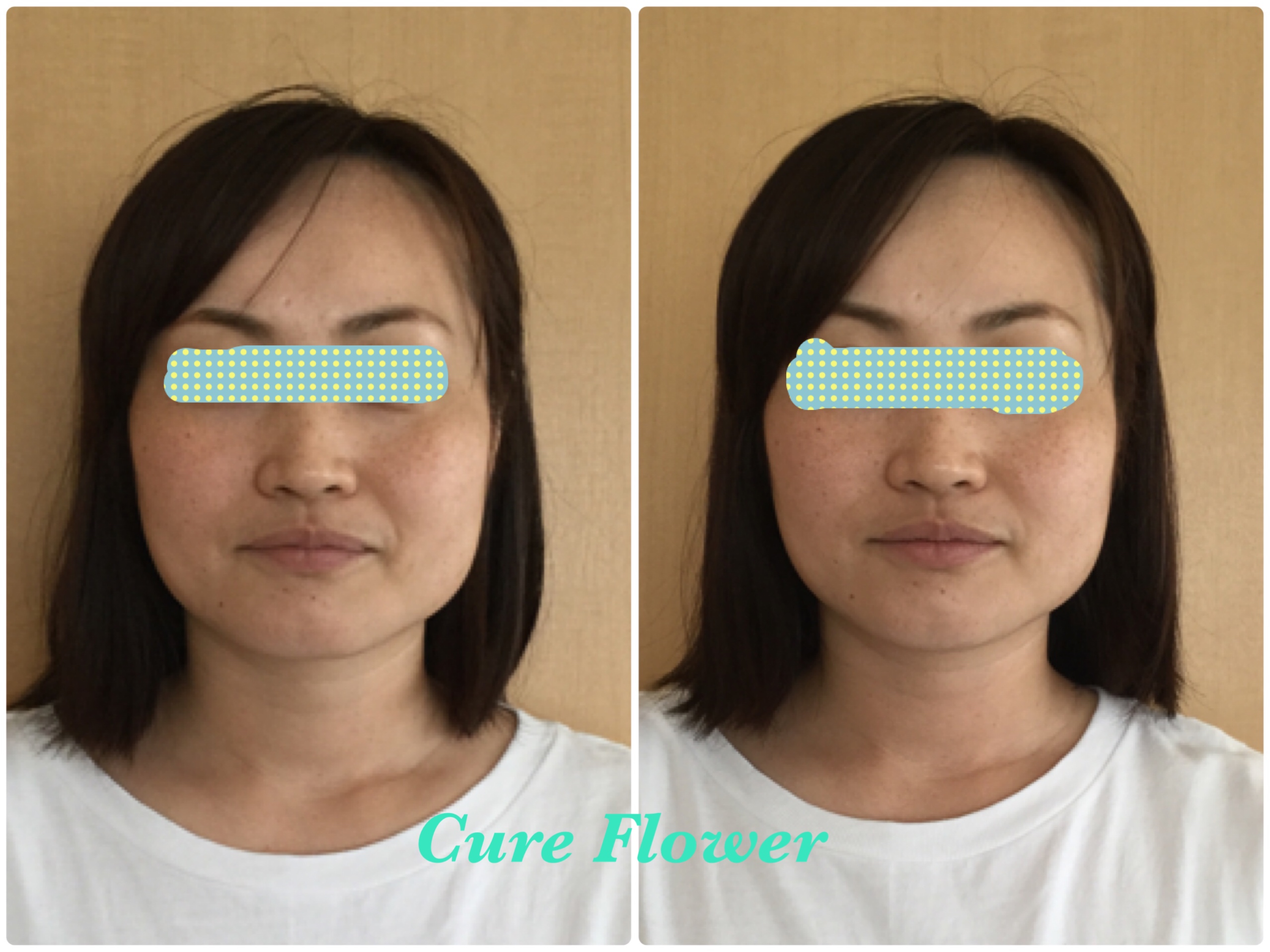 小顔矯正,　small face correction