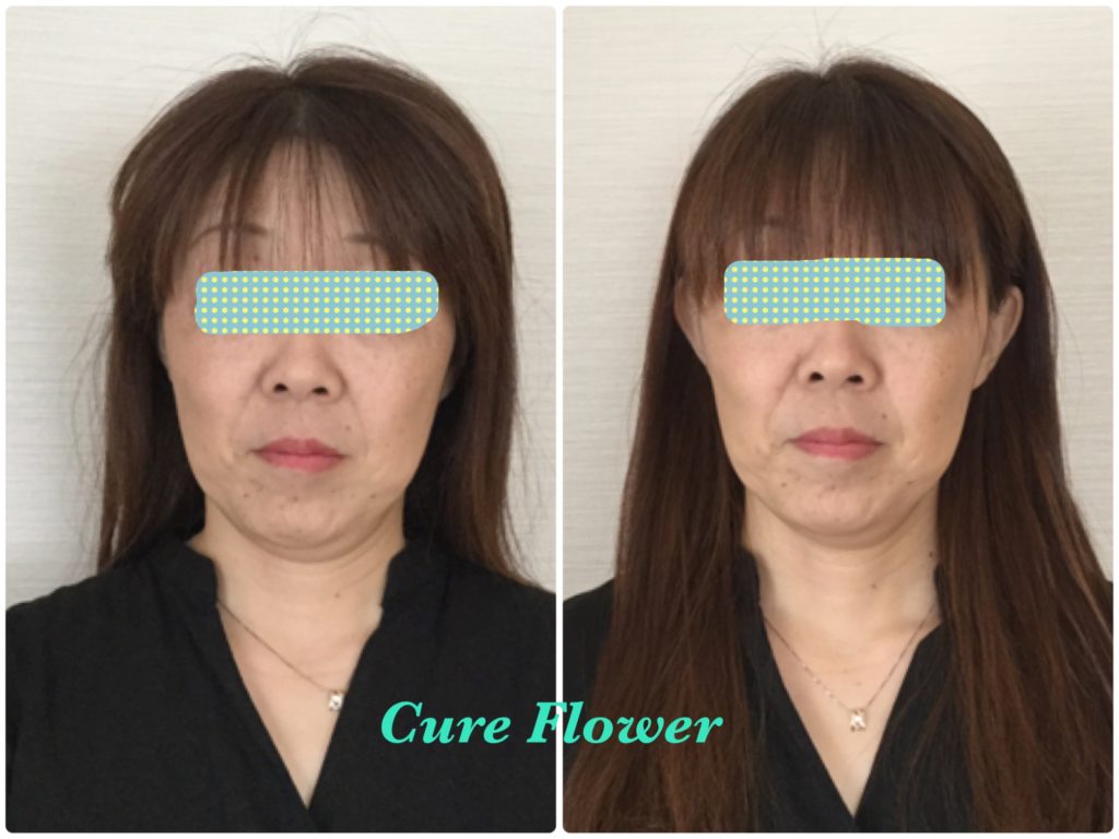 小顔矯正,　small face correction