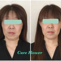 小顔矯正,　small face correction