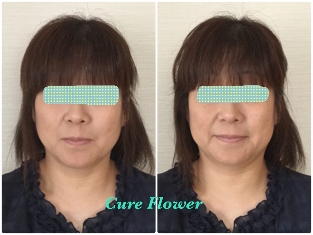 小顔矯正,　small face correction