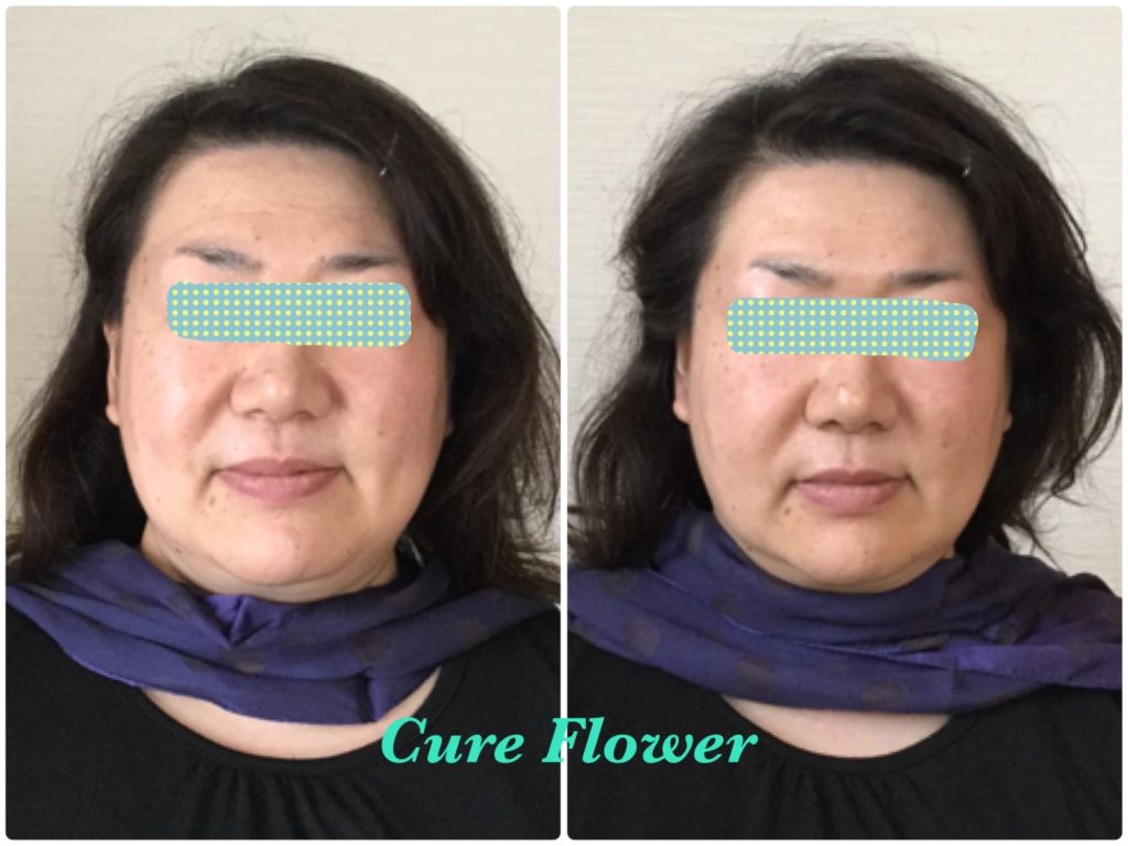 小顔矯正,　small face correction