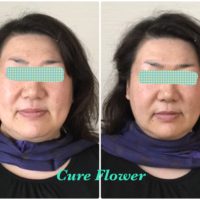 小顔矯正,　small face correction