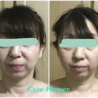 小顔矯正,　small face correction