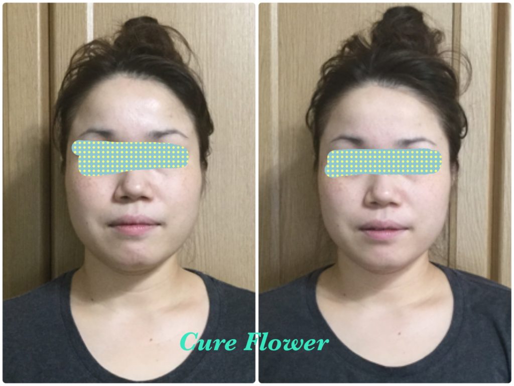 小顔矯正,　small face correction