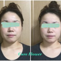 小顔矯正,　small face correction