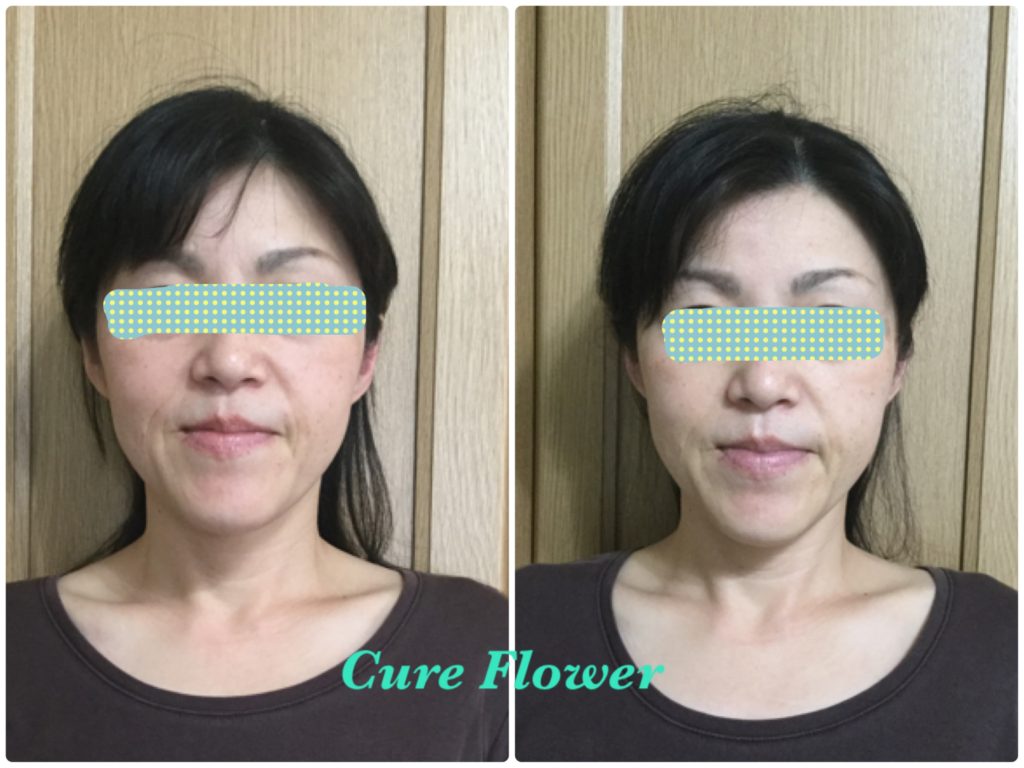 小顔矯正,　small face correction