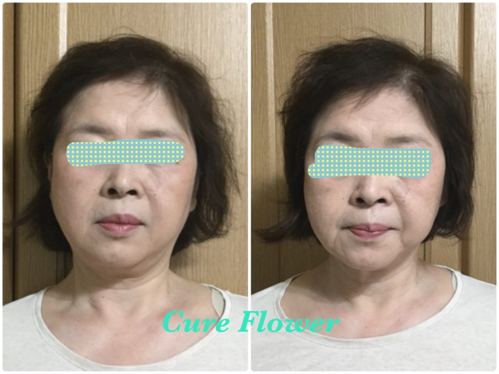 小顔矯正,　small face correction