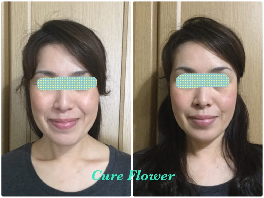 小顔矯正,　small face correction