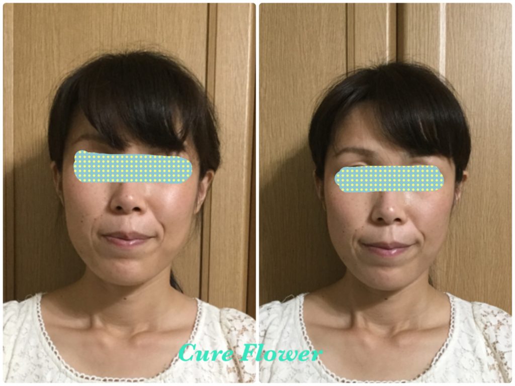 小顔矯正，　small face correction