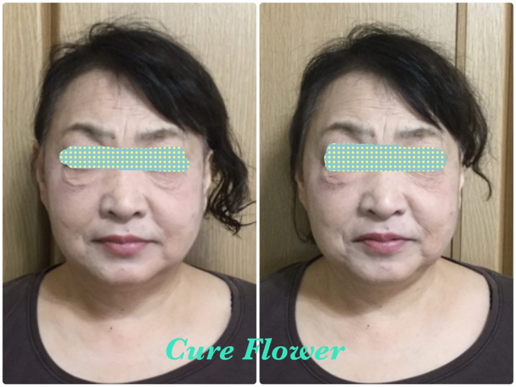 小顔矯正, small face correction