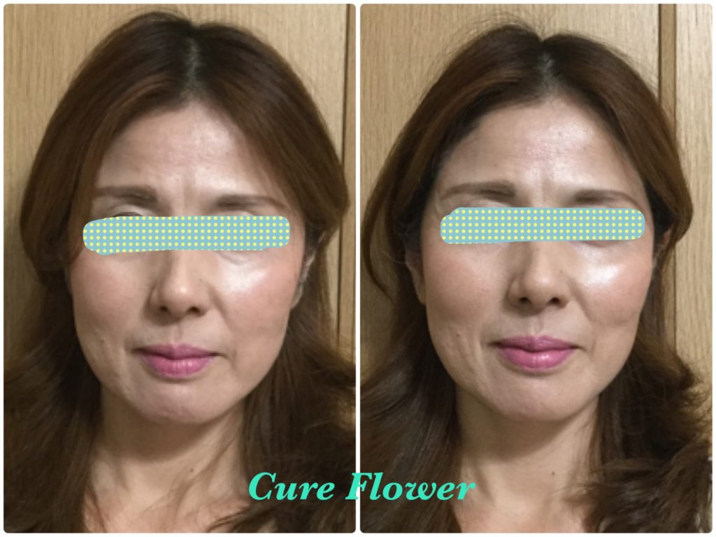 小顔矯正,　small face correction