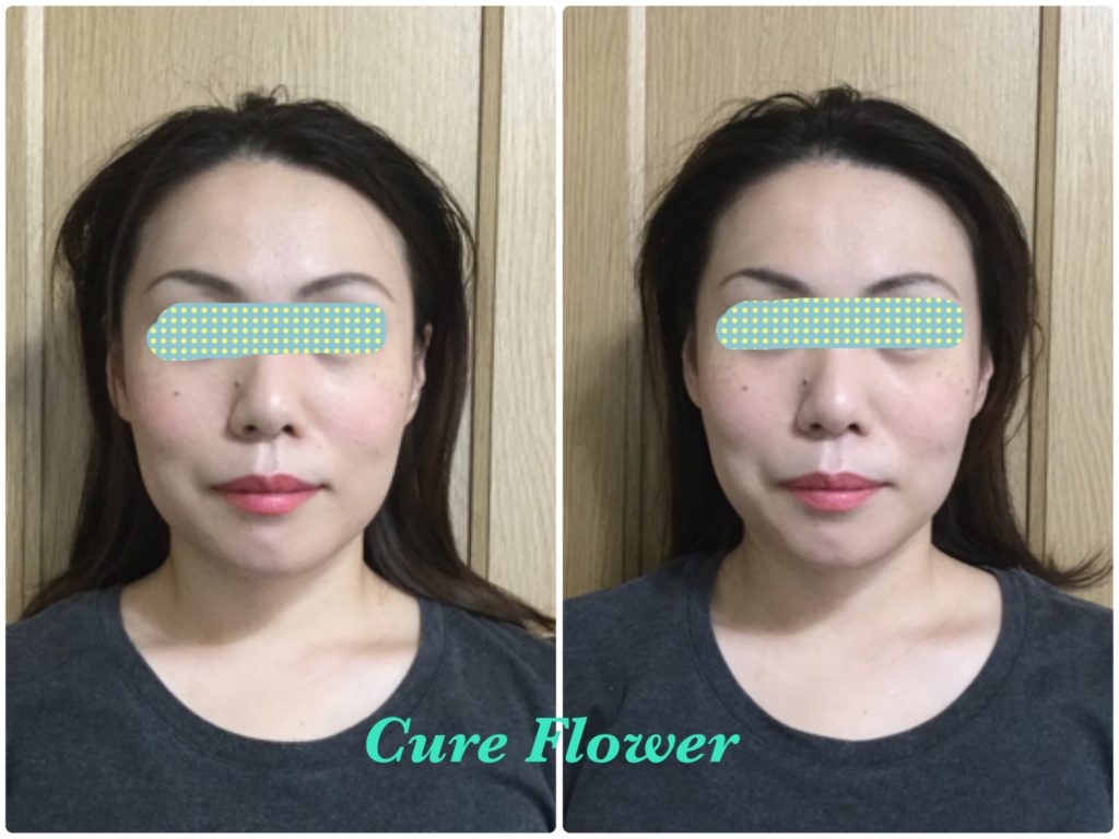 小顔矯正, small face correction
