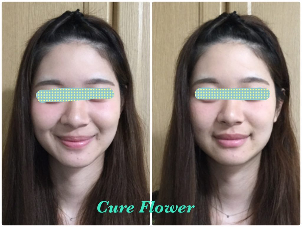 小顔矯正, small face correction