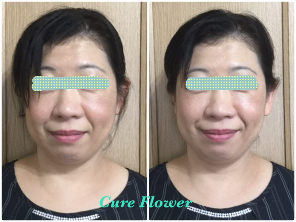 小顔矯正,　small face correction