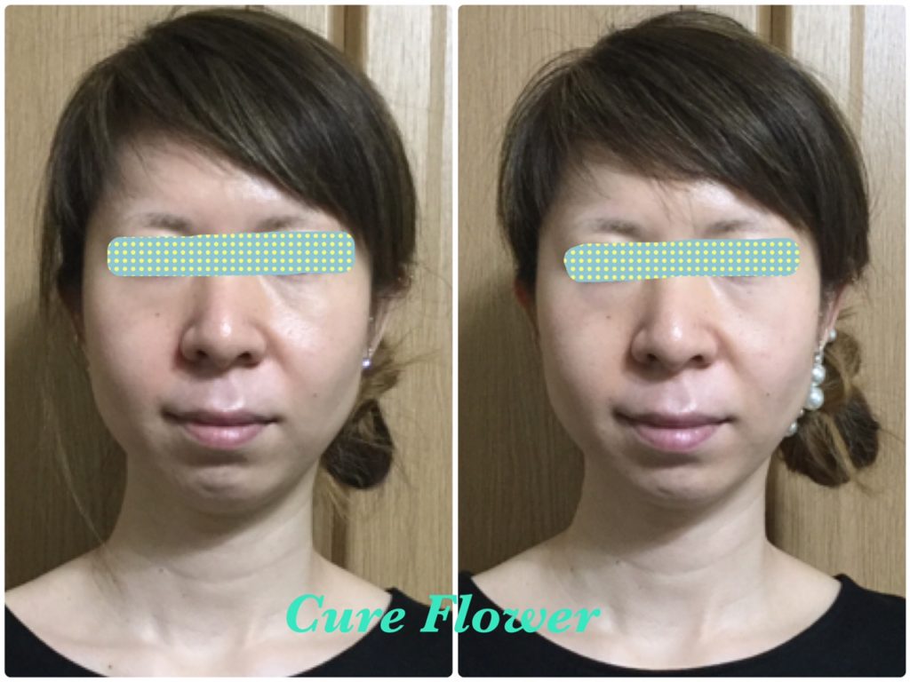 小顔矯正、small face correction