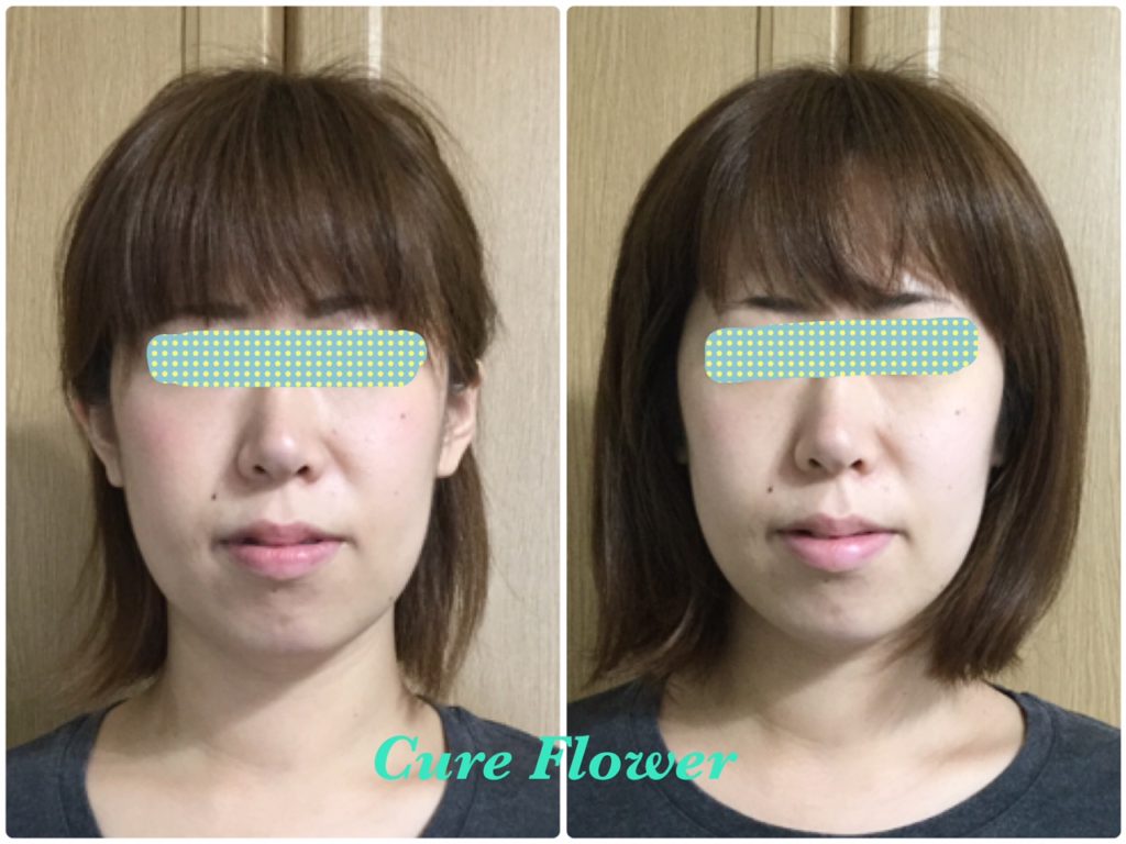 小顔矯正, small face correction