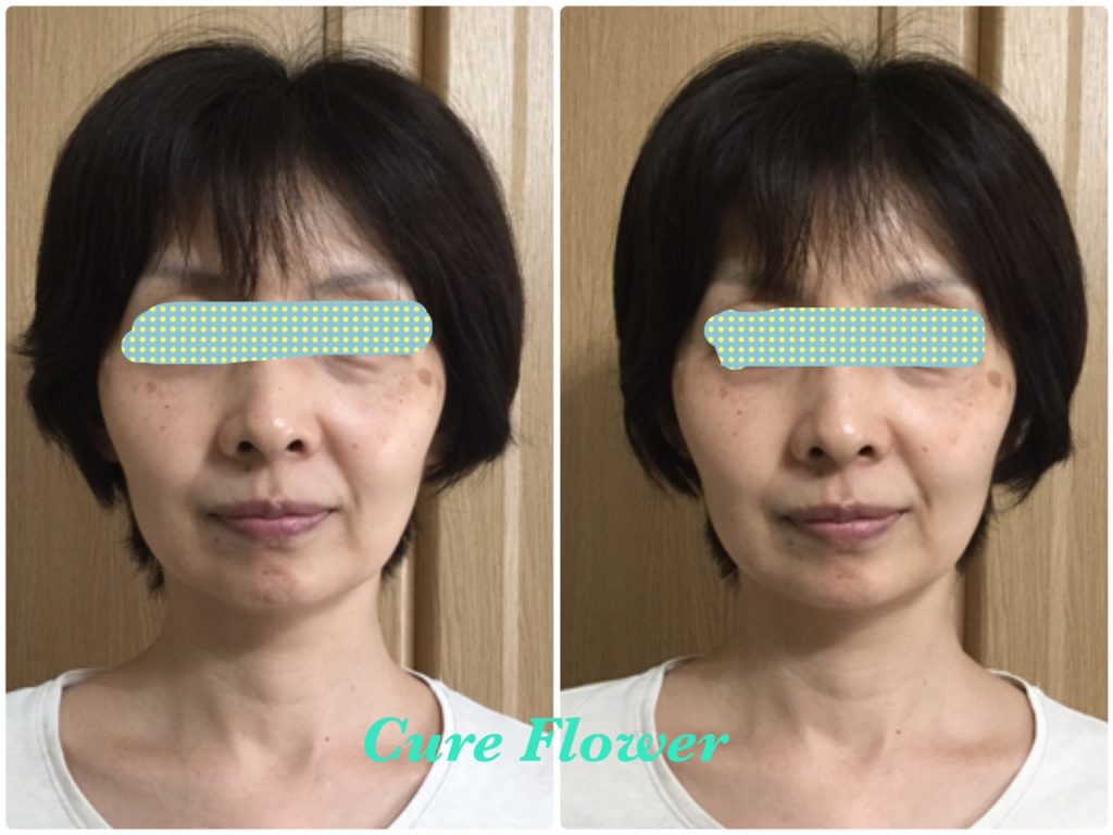 小顔矯正, small face correction