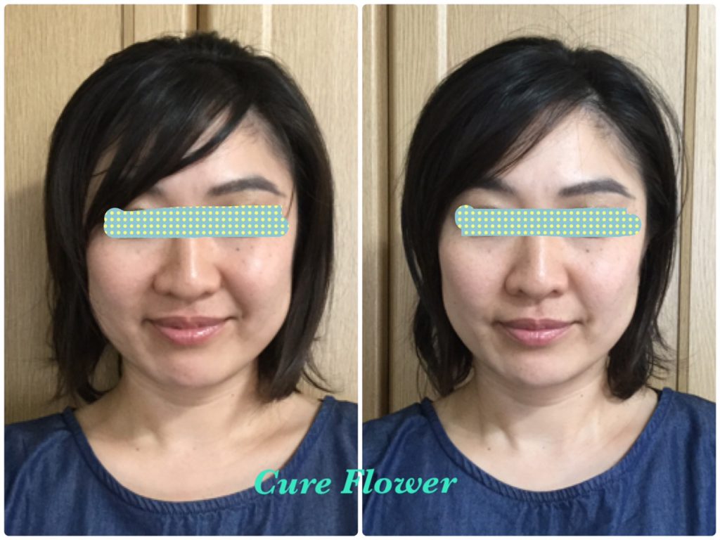 小顔矯正、small face correction