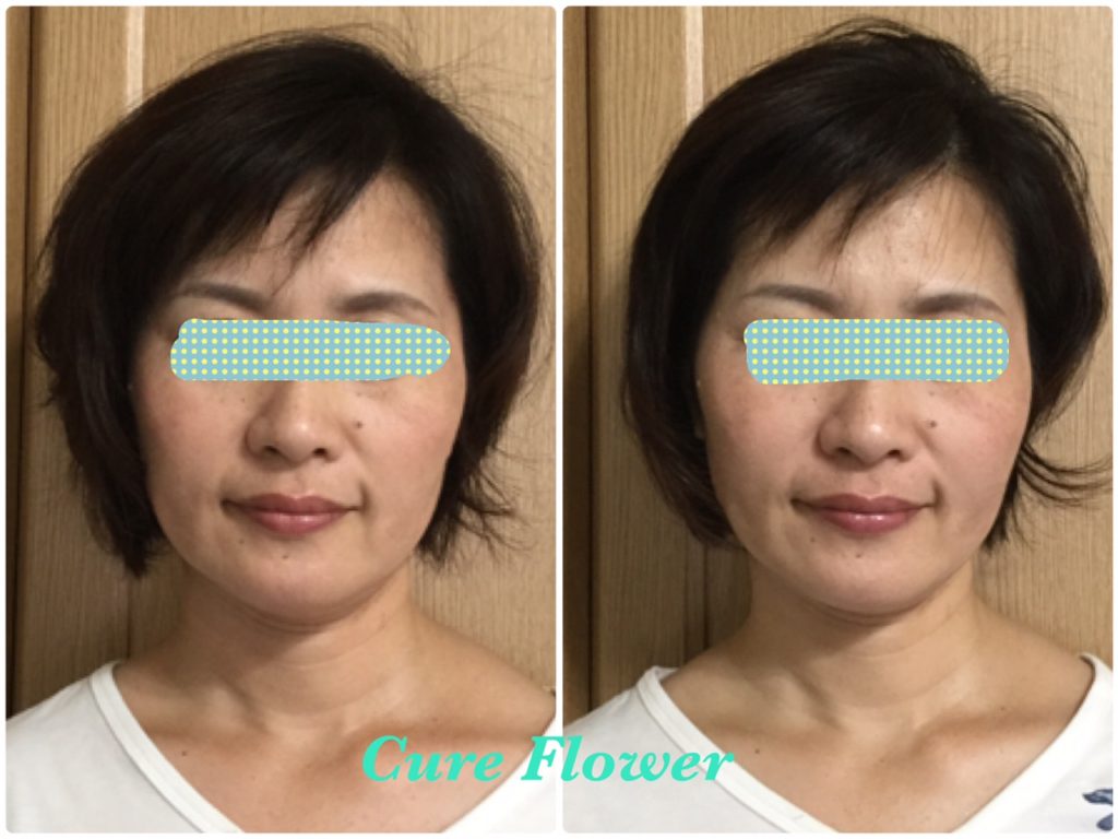 小顔矯正、small face correction